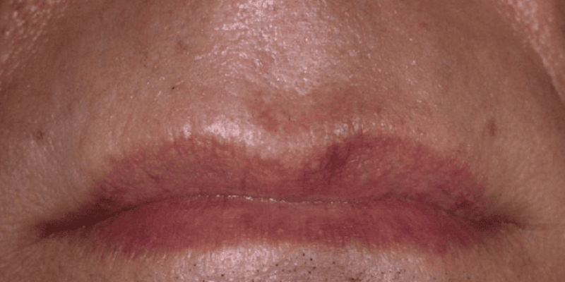 Laser Hair Removal mouth after