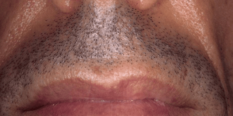 Laser Hair Removal mouth Before