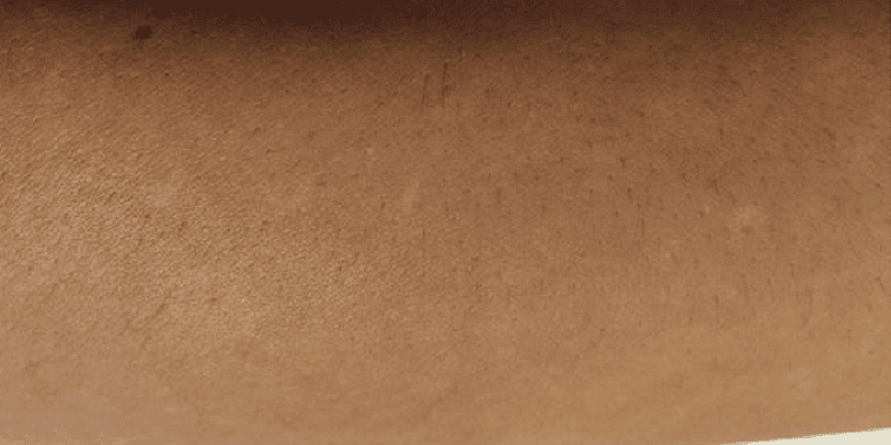 Laser hair Removal Forearm after