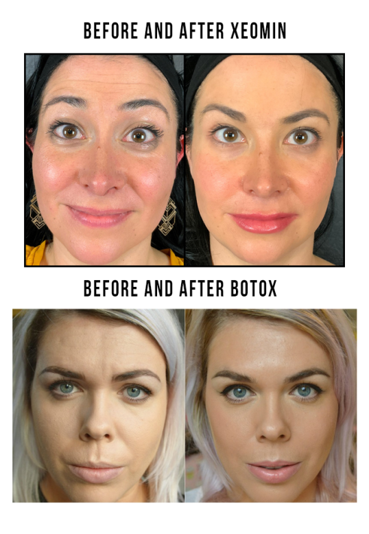 Before and After Xeomin and Botox