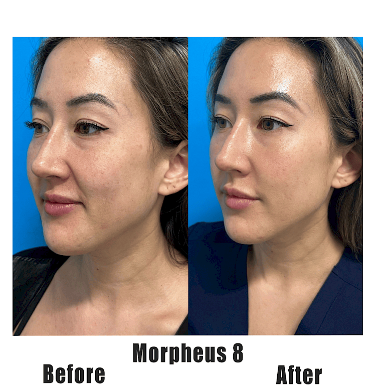 MORPHEUS8 Before and After