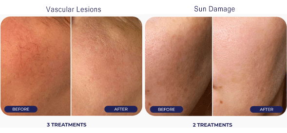 IPL Photofacial Before and After