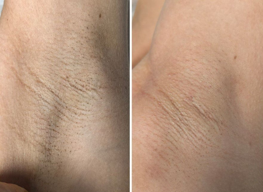 Underarm result