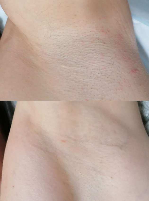 Underarm result