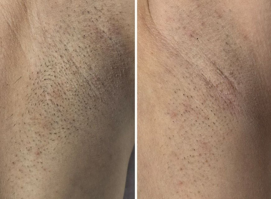 Underarm result