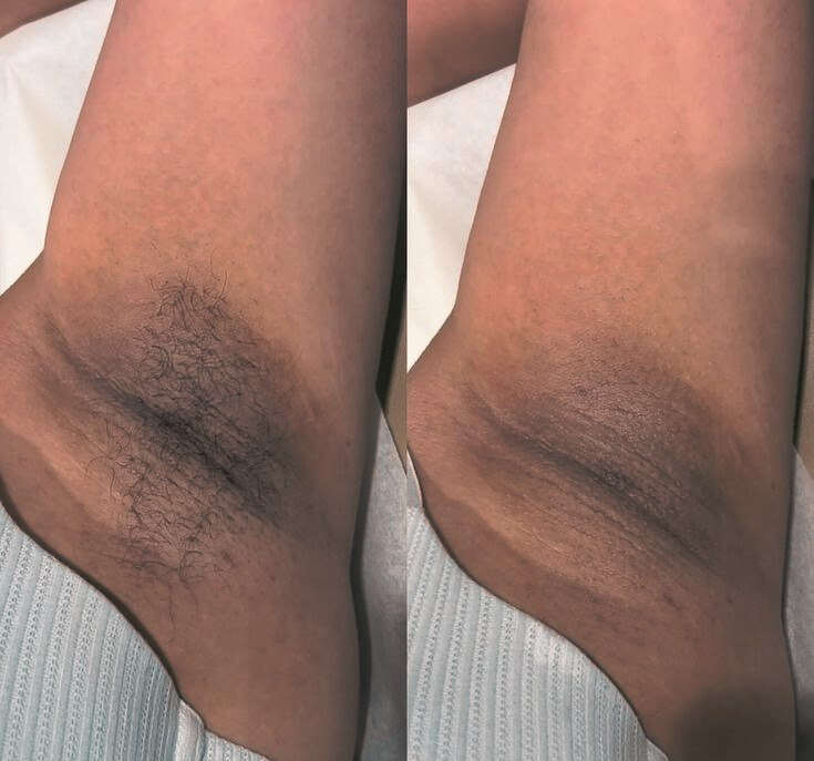 Underarm result