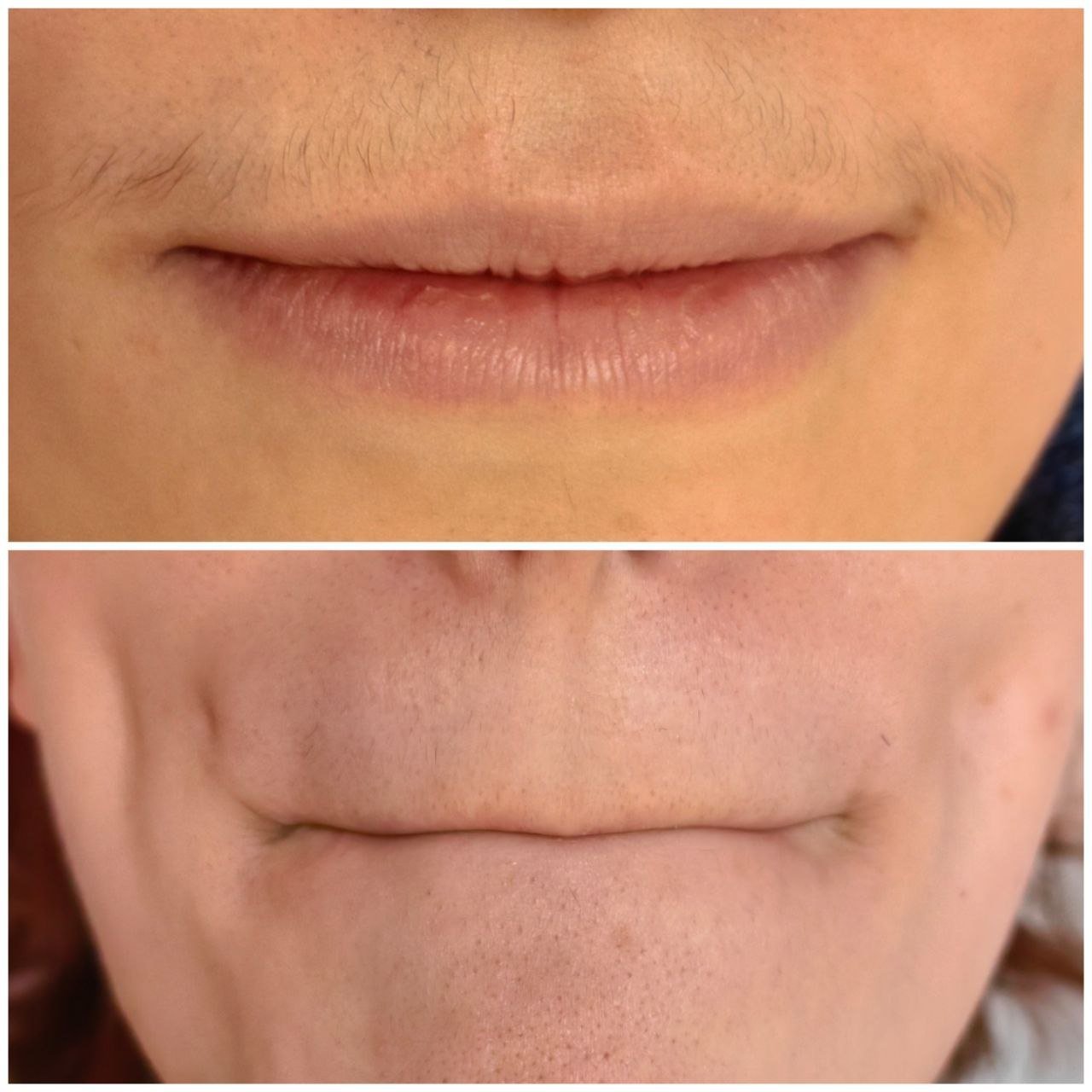 Upper Lip result