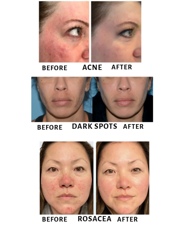LED Light Therapy Before and After
