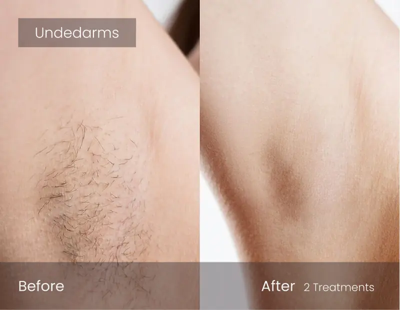 Before and after: Laser hair removal · underarms · 2 sessions