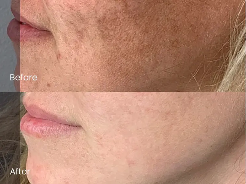 Before and after: Morpheus8 · lower face