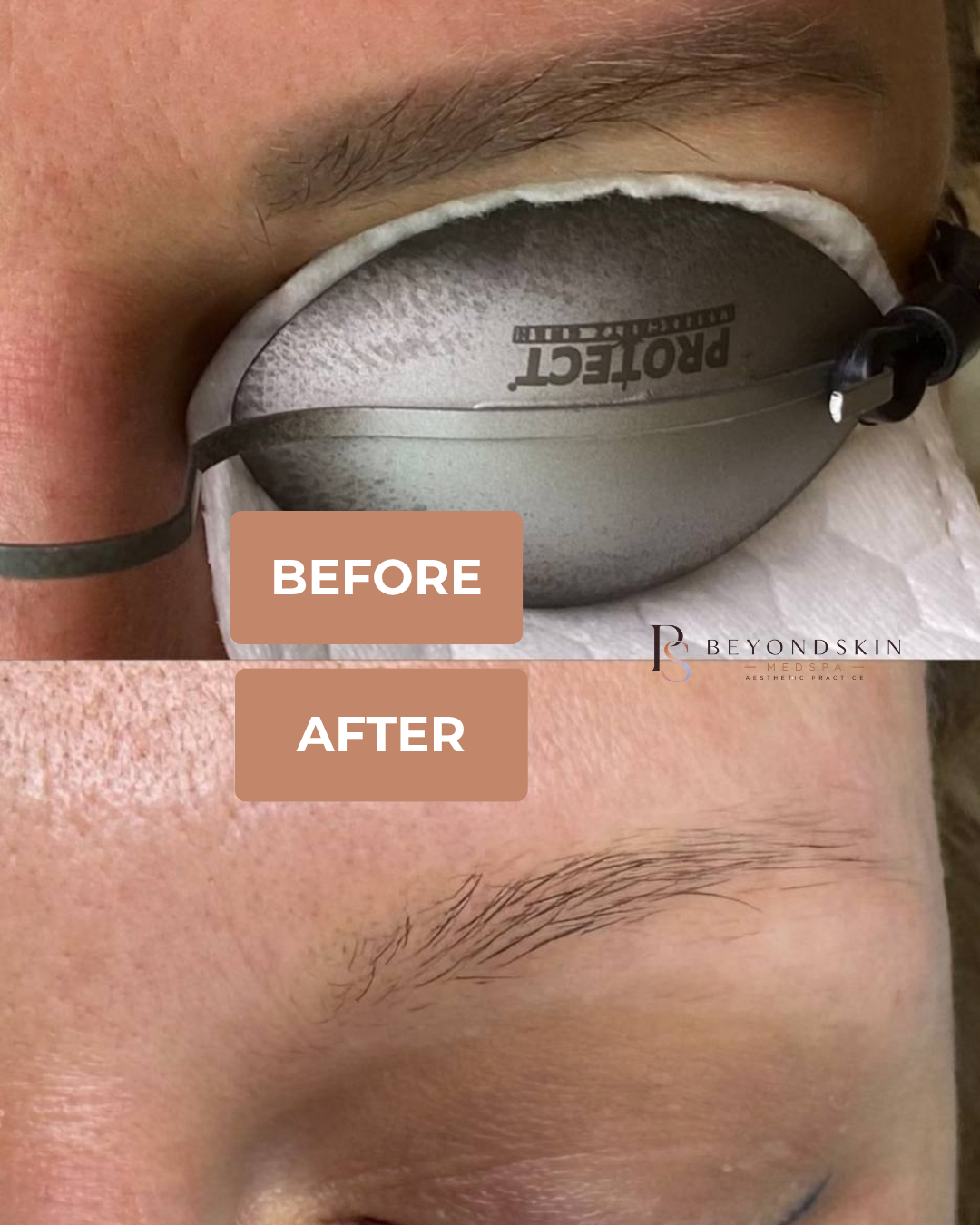 Eyebrow tattoo removal before and after, 3 sessions