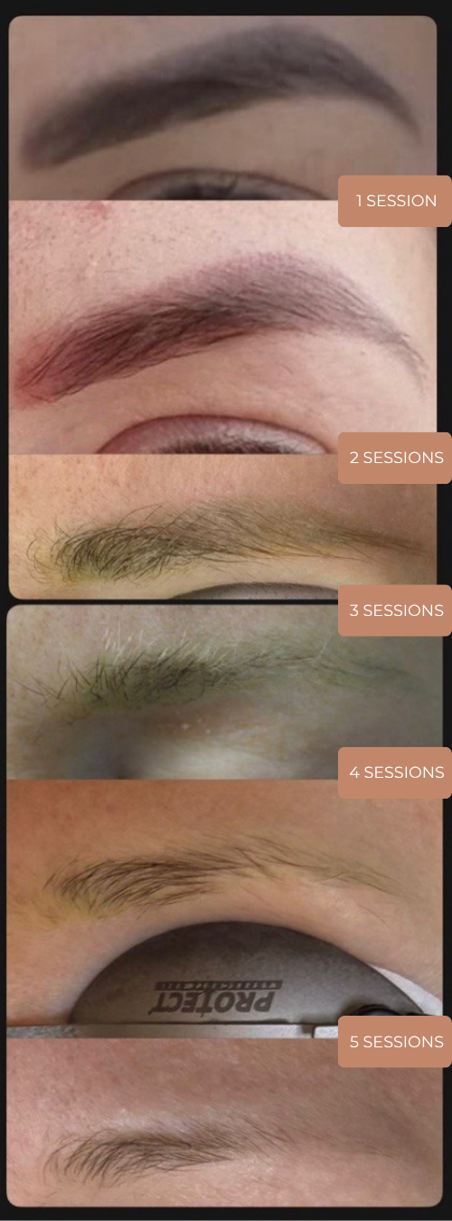 Complex eyebrow tattoo removal before and after, 5 sessions
