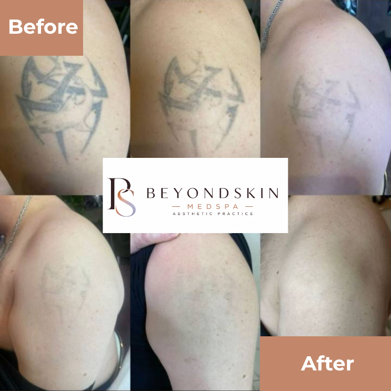 PicoSure Pro Tattoo Removal