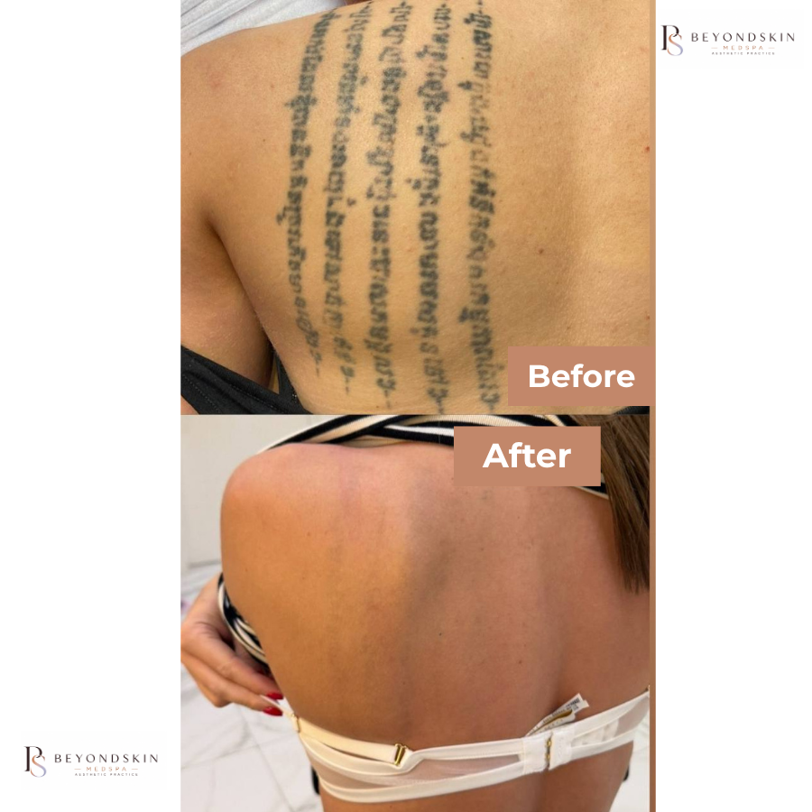 PicoSure Pro Tattoo Removal
