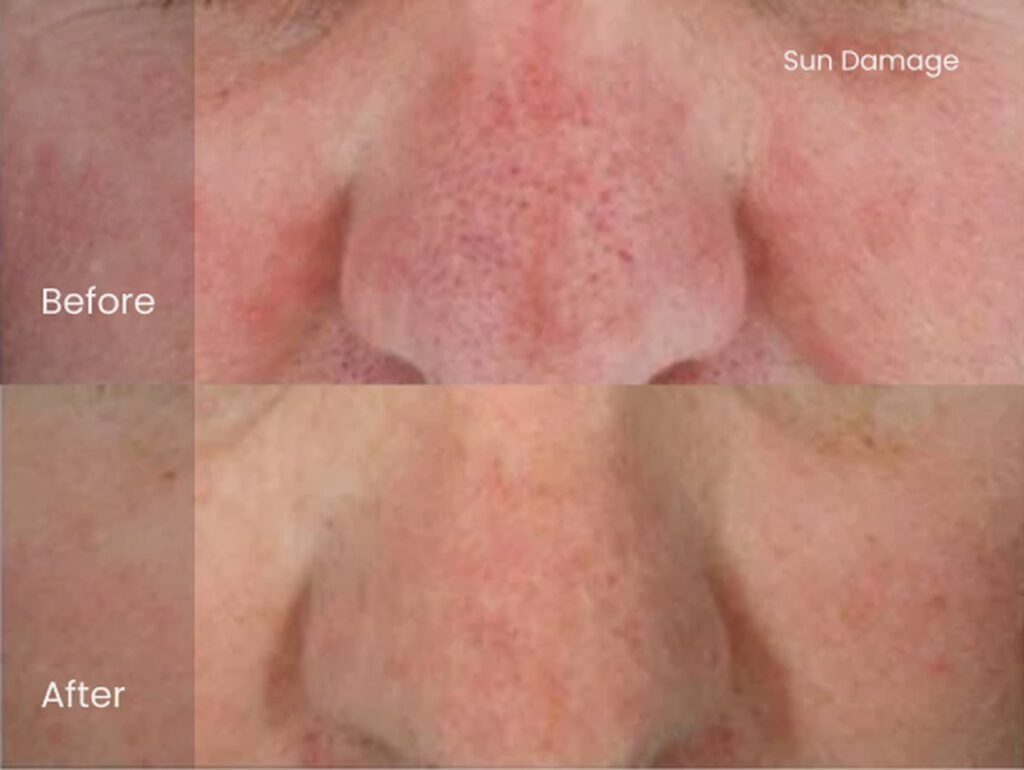 HydraFacial