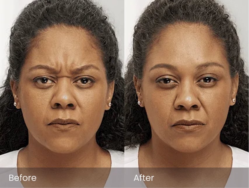 Botox