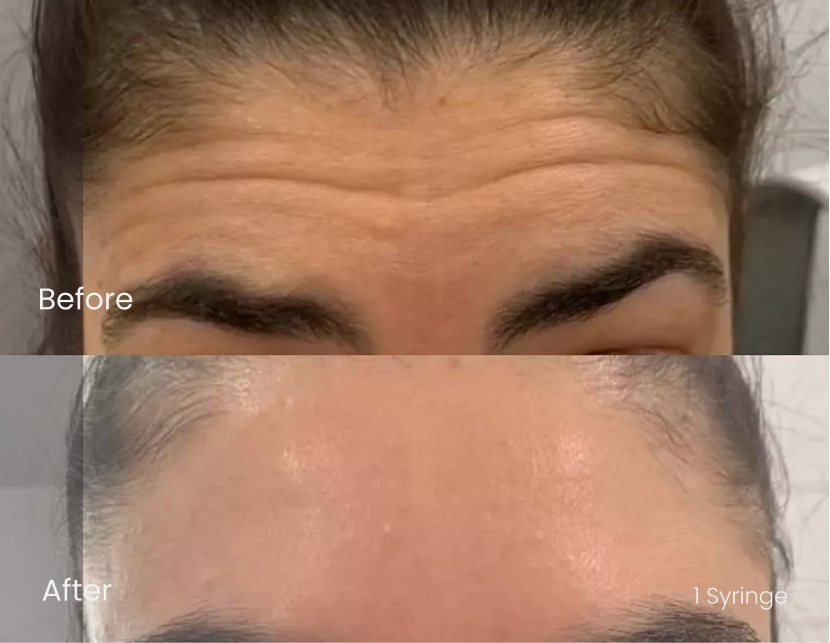 Injectables Forehead