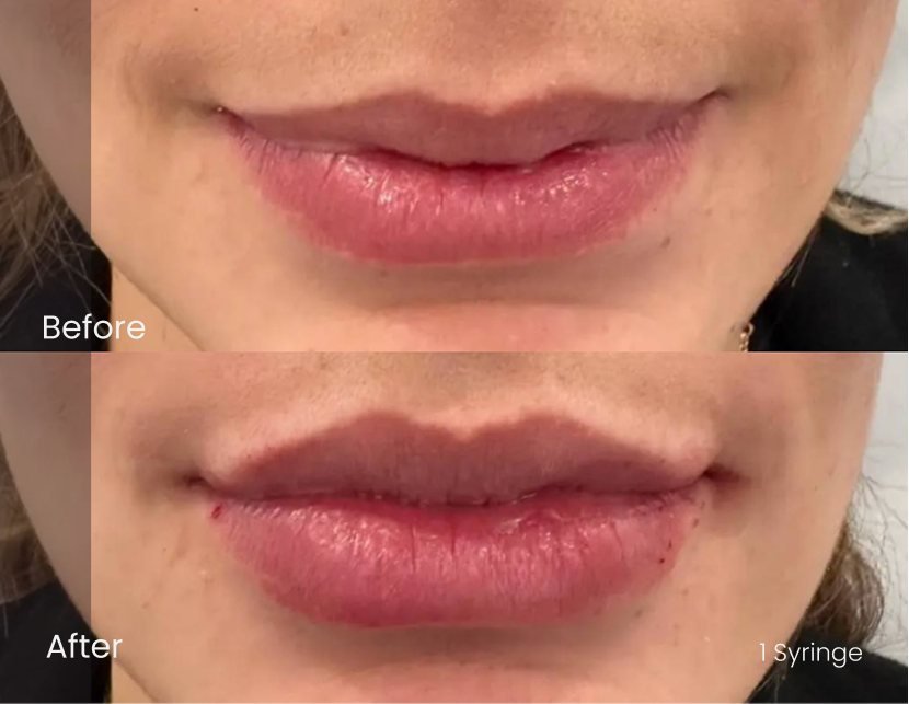 Injectables Lips