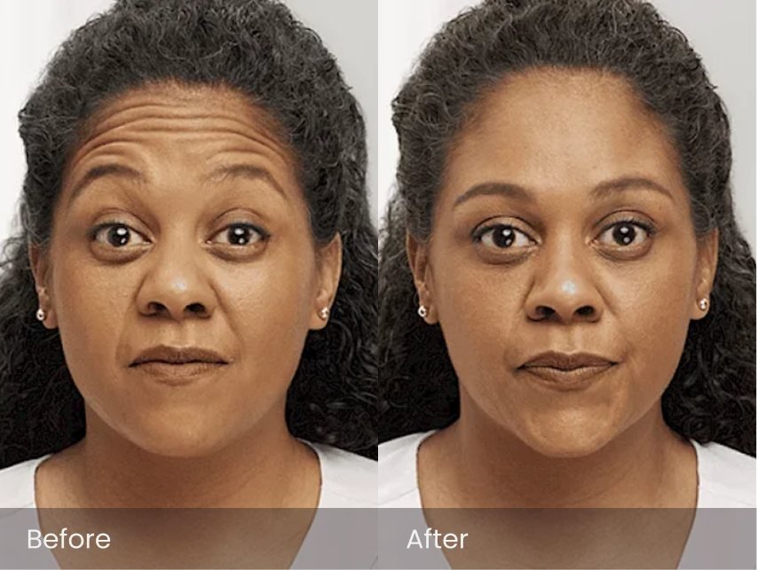 Botox