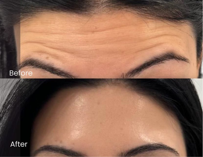 Injectables Forehead