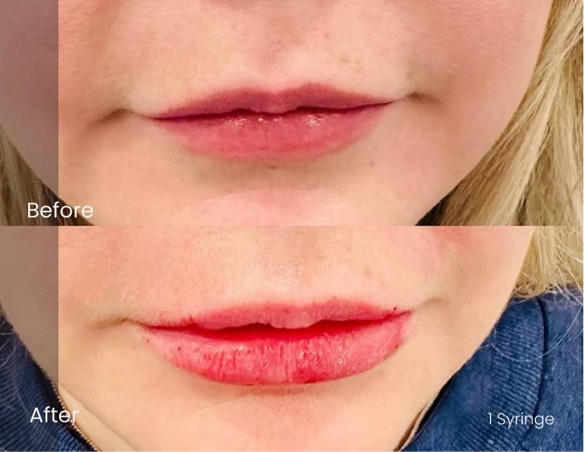 Juvederm Ultra Xc