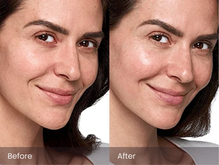 Skinvive by Juvederm