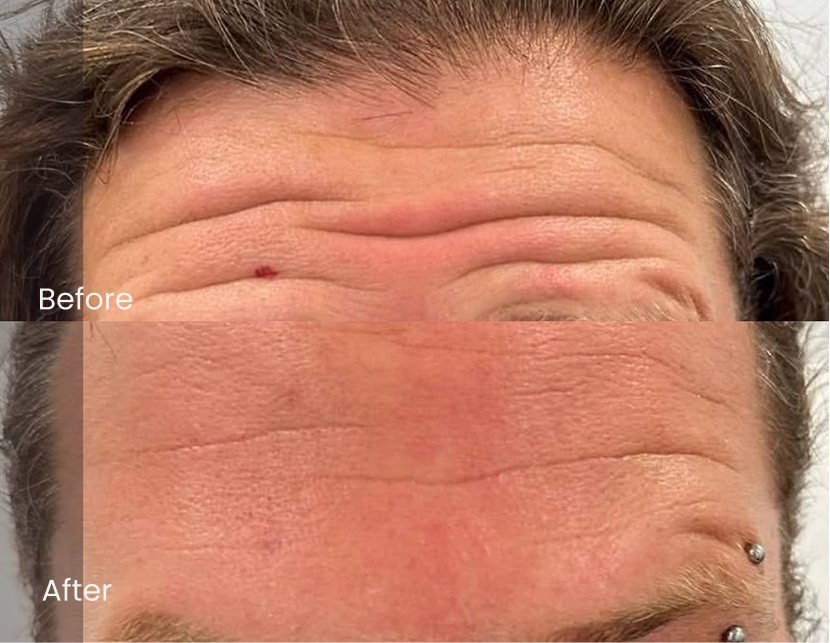 Injectables Forehead
