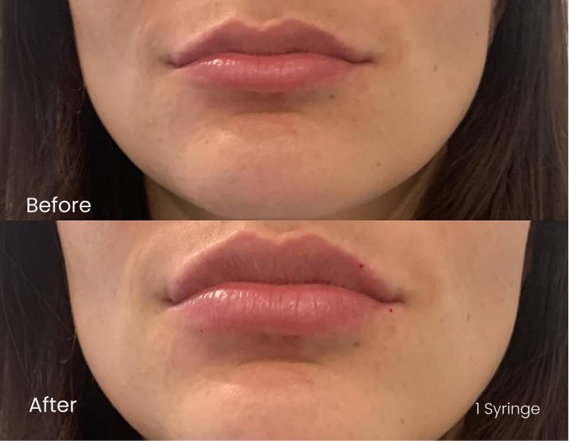 Injectables Lips