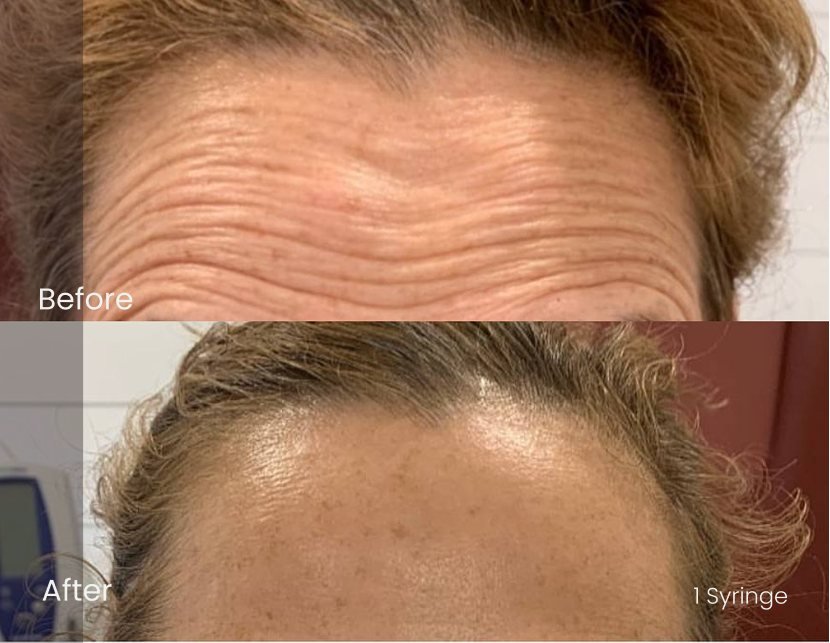 Injectables Forehead