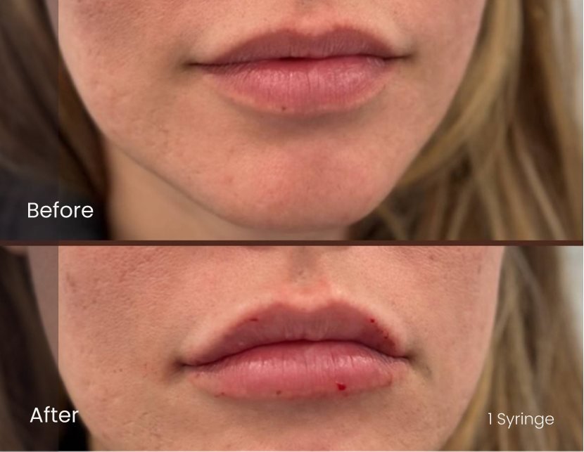 Injectables Lips