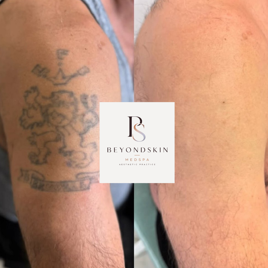 PicoSure Pro Tattoo Removal