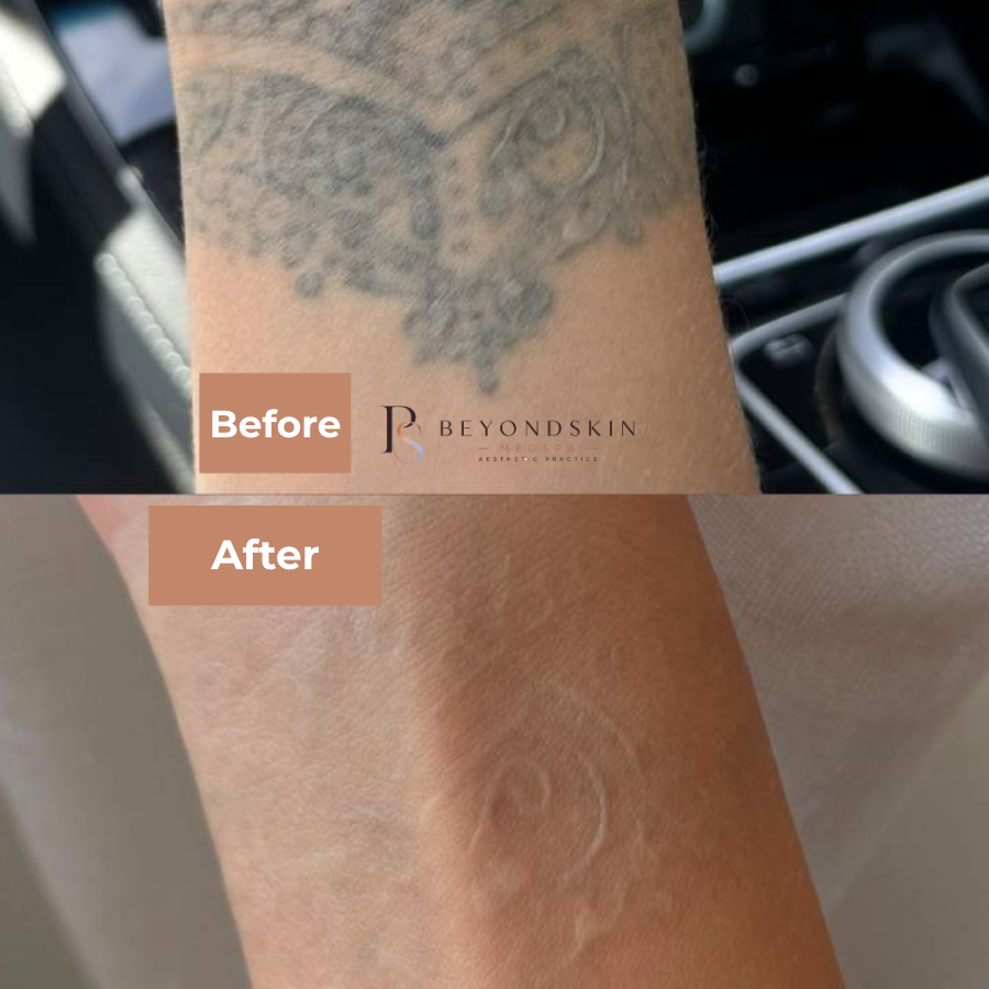 PicoSure Pro Tattoo Removal