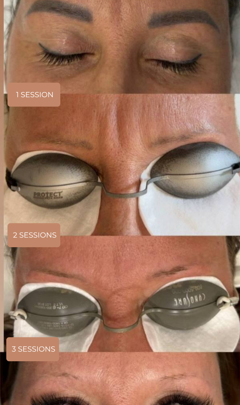 Dark black eyebrow tattoo removal before and after, 3 sessions