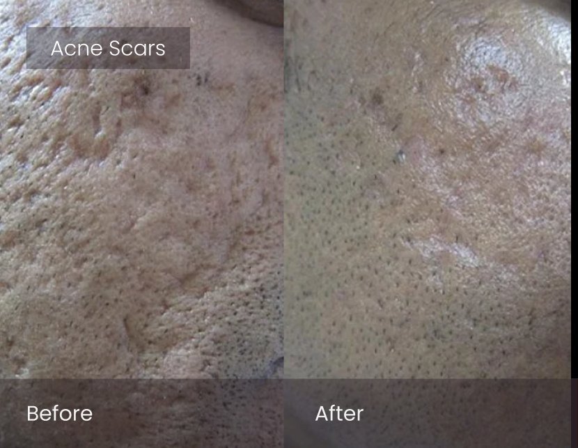 Laser Skin Resurfacing