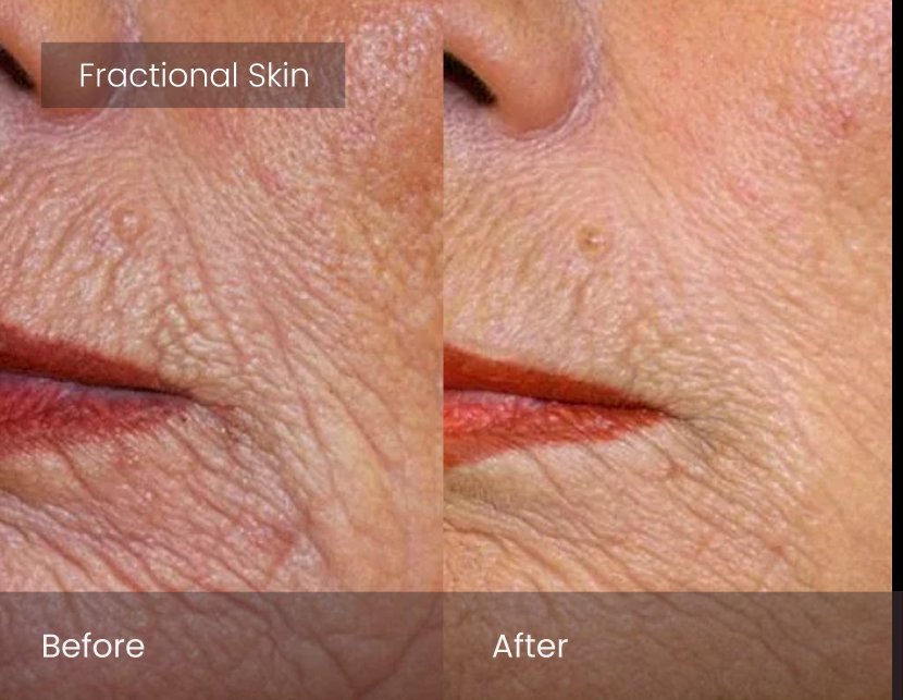 Laser Skin Resurfacing