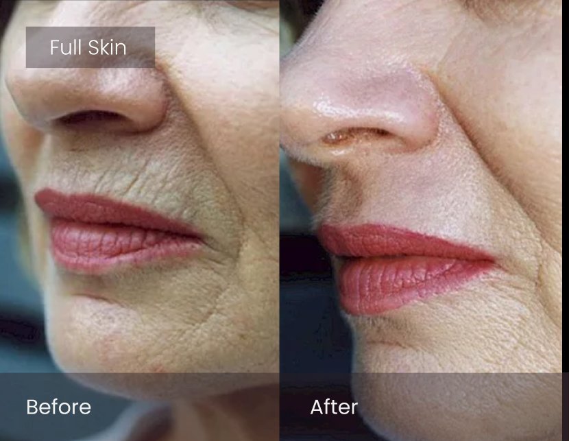 Laser Skin Resurfacing