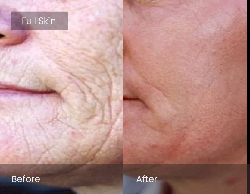 Laser Skin Resurfacing
