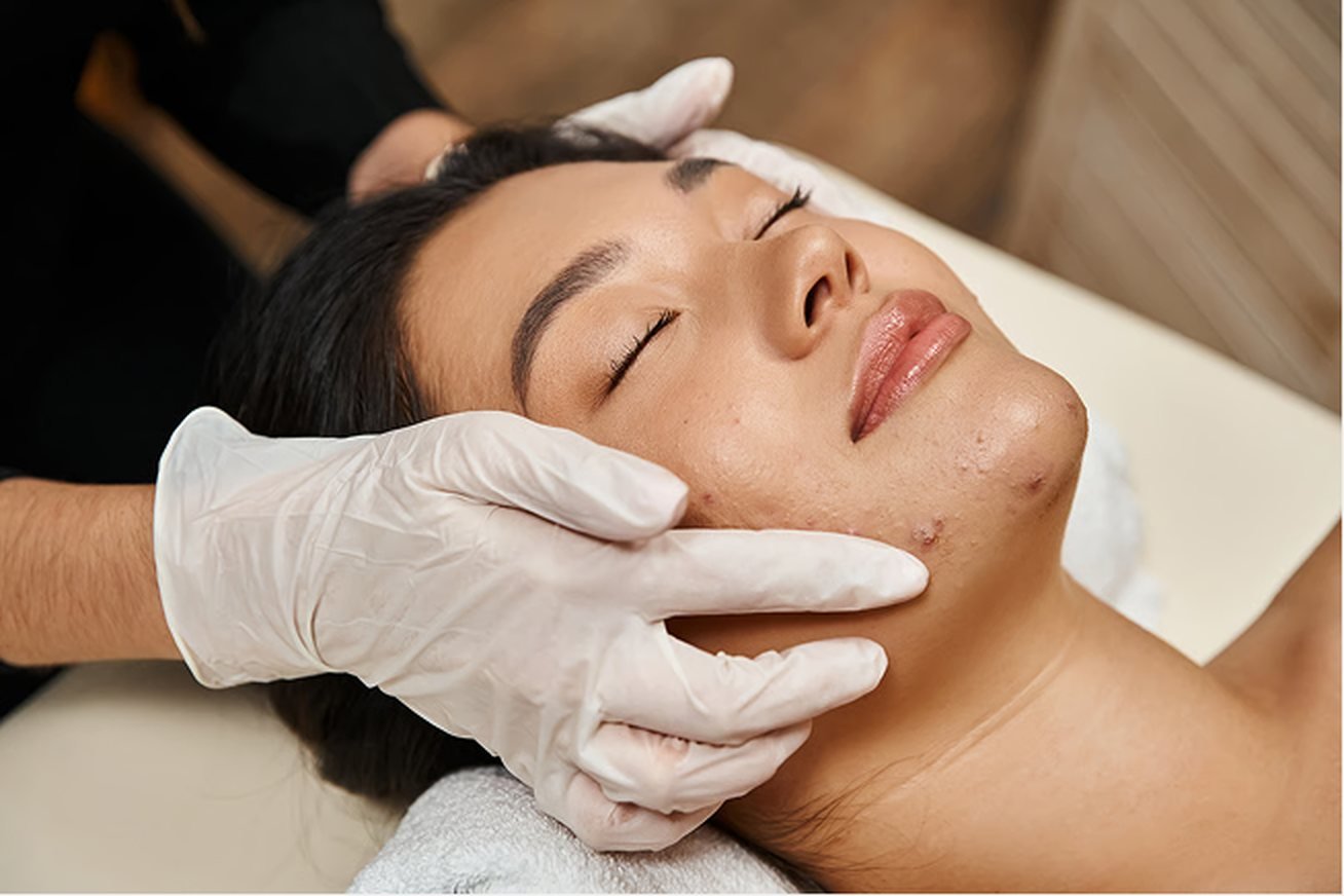 Acne Facial