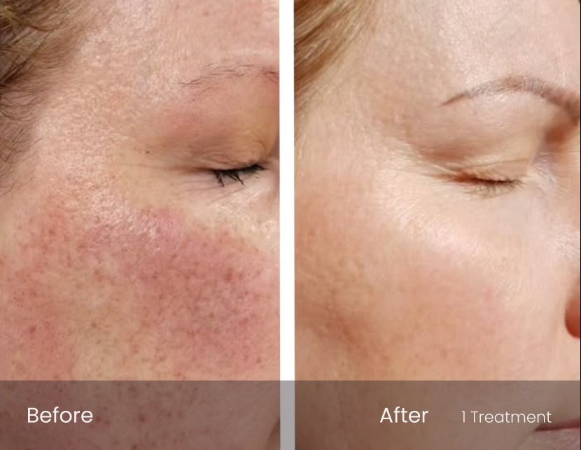IPL Photo Facial