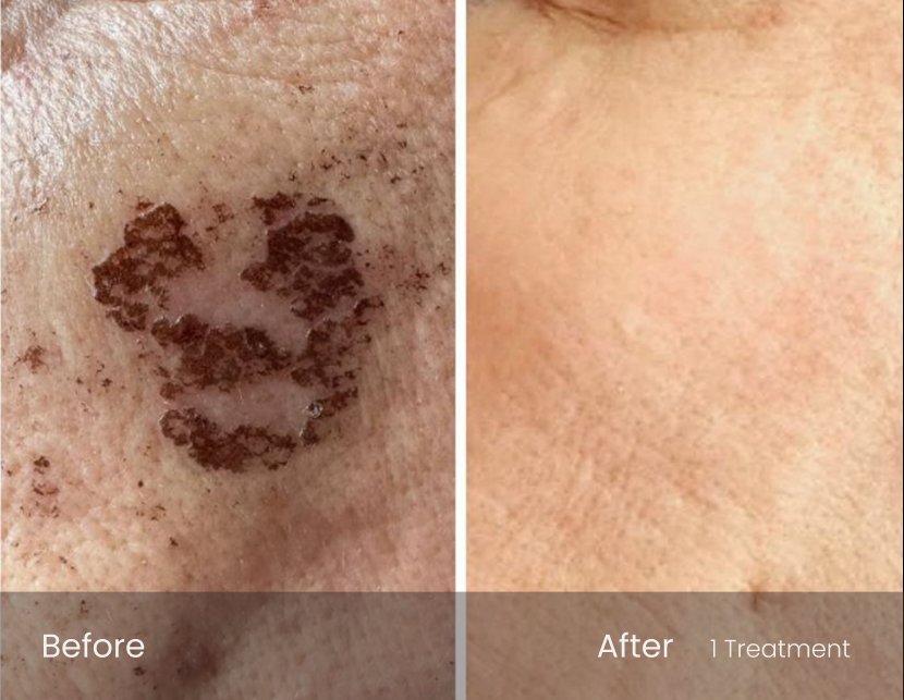 IPL Photo Facial