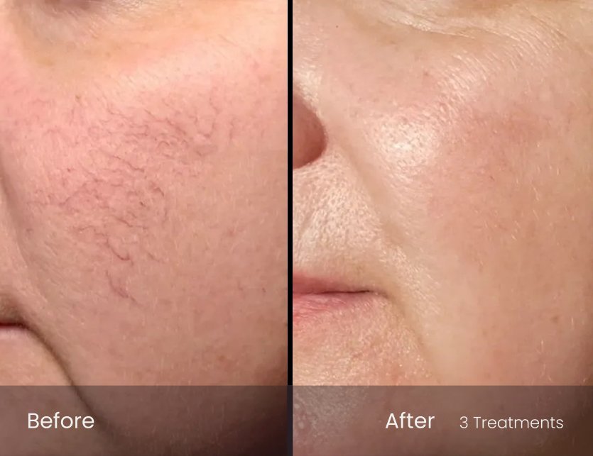 IPL Photo Facial