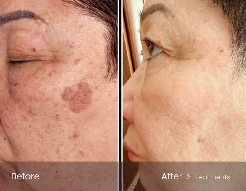 IPL Photo Facial