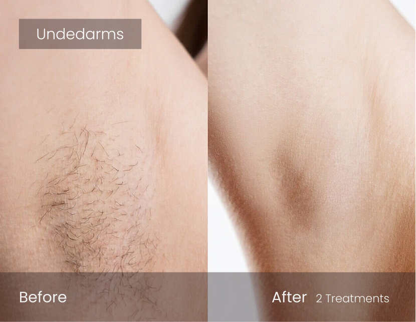 Laser Hair Removal