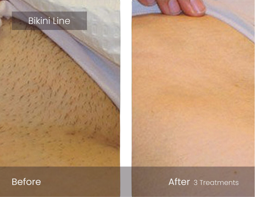 Laser Hair Removal