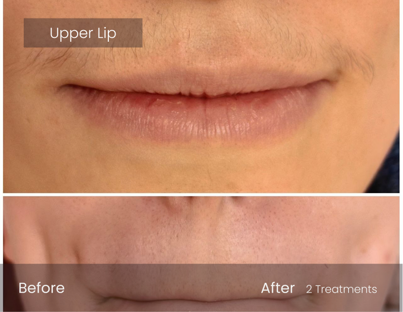 Laser Hair Removal