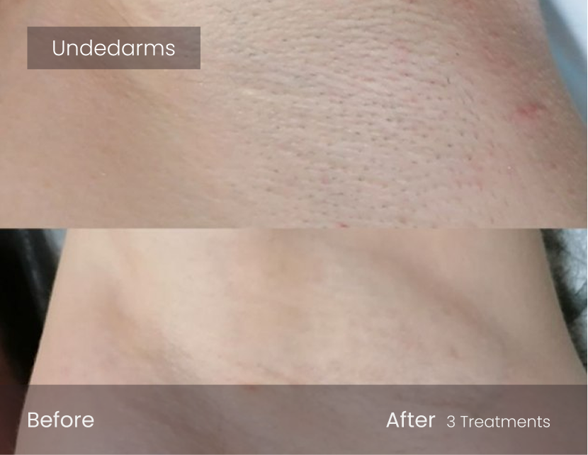 Laser Hair Removal