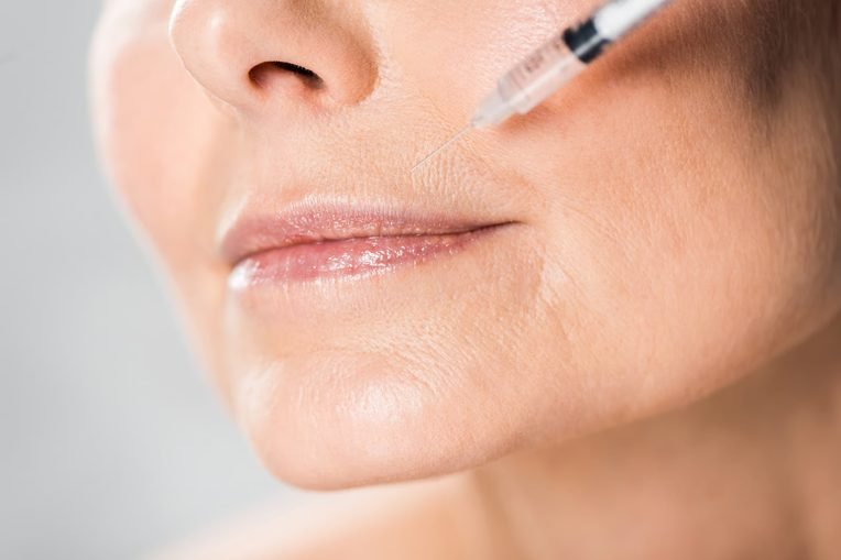 Injectables Nasal Labial Folds