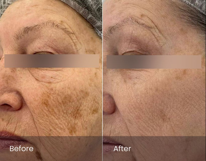 PicoSure Pro Rejuvenation