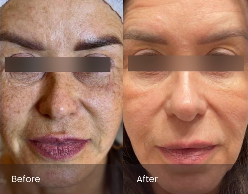 PicoSure Pro Rejuvenation