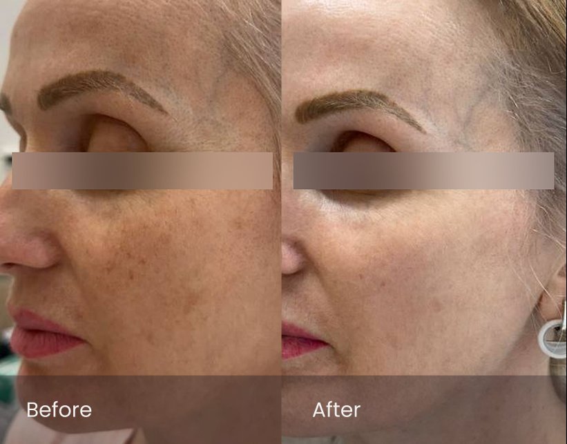 PicoSure Pro Rejuvenation